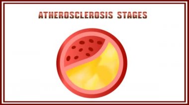 Ateroskleroz. Rahatsızlık lipid ve protein metabolizması, erteleme arterler içinde kolesterol plaklar.