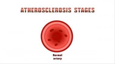 Ateroskleroz. Rahatsızlık lipid ve protein metabolizması, erteleme arterler içinde kolesterol plaklar.
