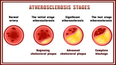 Ateroskleroz. Rahatsızlık lipid ve protein metabolizması, erteleme arterler içinde kolesterol plaklar.