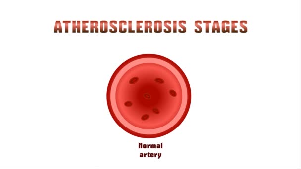 Ateroskleróza Poruchy Lipidů Metabolismus Bílkovin Odročení Cholesterol Plakety Tepnách — Stock video