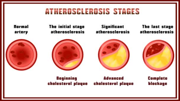 Atherosclerose Verstoring Van Stofwisseling Van Eiwit Lipide Onderbreking Cholesterol Plaques — Stockvideo