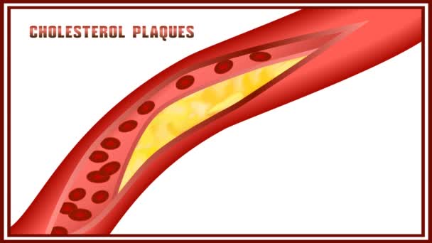 Atherosclerosis Disturbance Lipid Protein Metabolism Adjournment Cholesterol Plaques Arteries — Stock Video