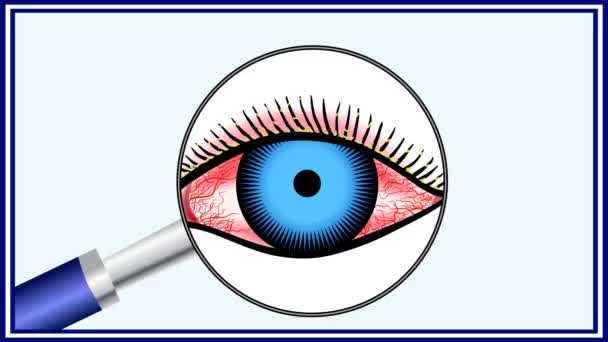 Demodex Enfermedad Ocular Parasitaria Animación Con Designación — Vídeo de stock