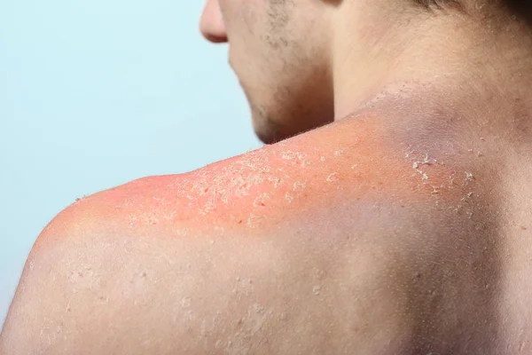 Schilfering van de huid na zonnebrand — Stockfoto