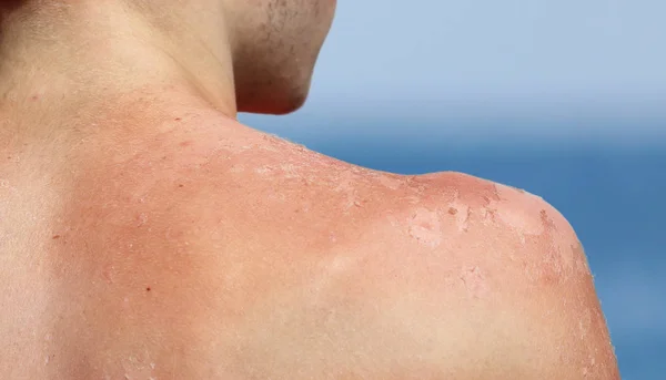 Young boy skin is  peeling  after sunburn — Stock Photo, Image