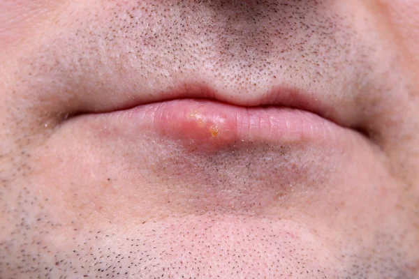 Herpes Sulle Labbra Doloroso Una Malattia Virale — Foto Stock