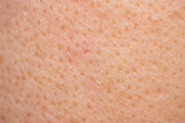 Acne Skin Face Woman Problem Skin Macro — Stock Photo, Image