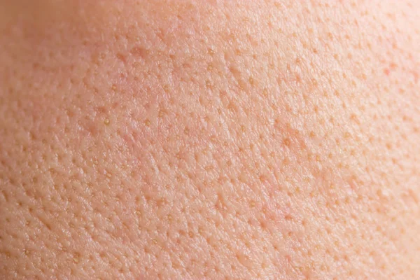 顔の女性 トラブル肌にきび肌 マクロ — ストック写真