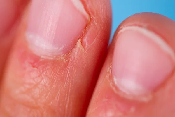 Zúzódások az ujjakon — Stock Fotó