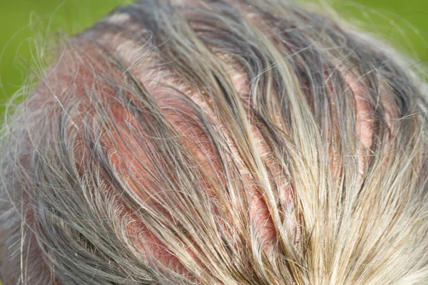 Alopecia humana o caída del cabello — Foto de Stock