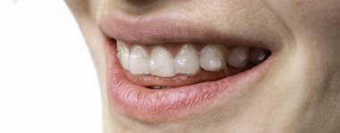 Beyaz arka plan üzerinde diş diş telleri aligner ile genç kadının mutlu gülümseme