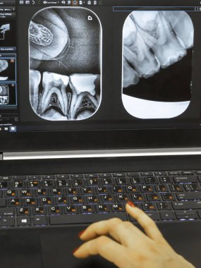 bir hastanın röntgeni diş hekimi gösterir