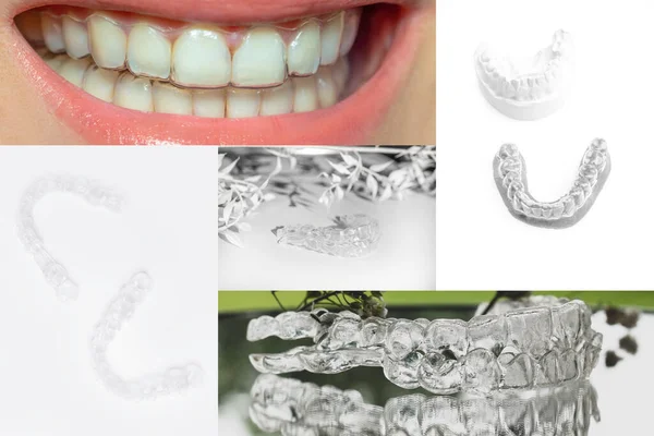 Colagem Dentes Com Aparelho Ortodôntico Belo Sorriso Com Aparelho Transparente — Fotografia de Stock