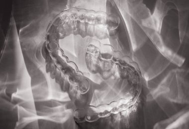 Modern diş saydam hizalayıcılar veya kozmetik dişçilikte dişleri düzeltmek için diş telleri ve moda çiçek gölgeleriyle ortodonti, seçici odak