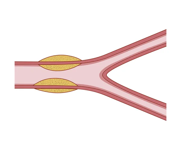 Vasculitis. Vernietig de bloedvaten — Stockvector