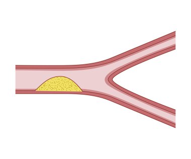 Ateroma. Kan Damarları.