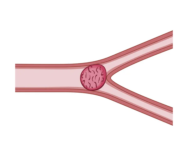 Embolisme vaisseaux sanguins — Image vectorielle