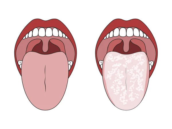 건강에 좋은 혀와 하얀 혀를 깨끗하게 하라. — 스톡 벡터