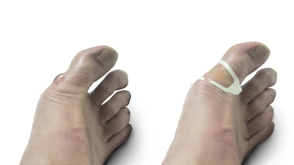 Close-up of man's foot with a large blister filled with bloody fluid on the inside of the foot and the foot with a gel band aid applied after draining the liquid from the blister — Stock Photo, Image