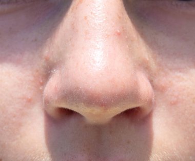 Burun genç kız closeup ön görünüm akne