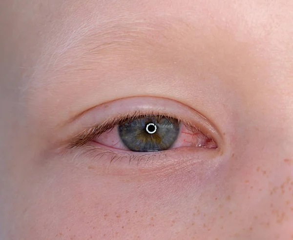 One eye of a teenager with conjunctivitis, macro closeup — Stock Photo, Image