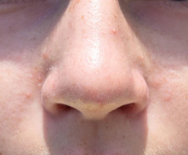 Neus tiener meisje close-up vooraanzicht acne — Stockfoto