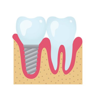 Diş kron ve implantasyon