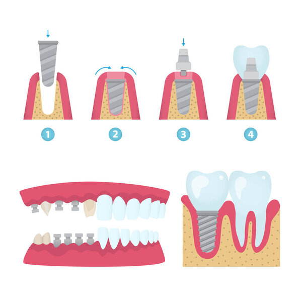 Dental crowns and implantation