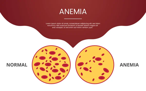 Anämie-Blutkörperchen-Konzeptthema für Template-Banner oder Landeshomepage-Infografiken - Vektor — Stockvektor