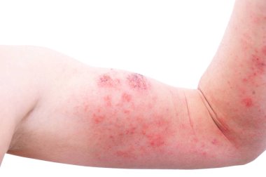 Atopik dermatit (Ad), olarak da bilinen Atopik Egzama (Dermatit) deri iltihabı dibinde türüdür.