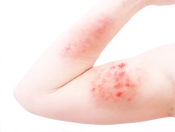 Atopic Dermatitis Also Known Atopic Eczema Type Inflammation Skin Dermatitis — Stock Photo, Image