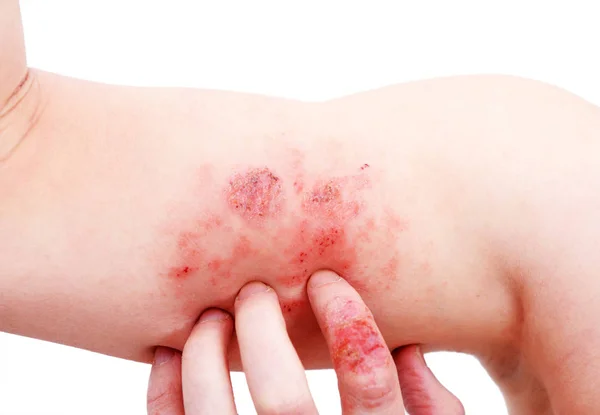 Atopic Dermatitis Also Known Atopic Eczema Type Inflammation Skin Dermatitis — Stock Photo, Image