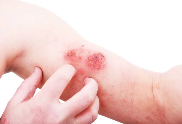 Atopische Dermatitis Ook Bekend Als Atopische Eczeem Een Soort Ontsteking — Stockfoto