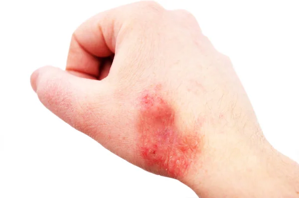 Atopic Dermatitis Also Known Atopic Eczema Type Inflammation Skin Dermatitis — Stock Photo, Image