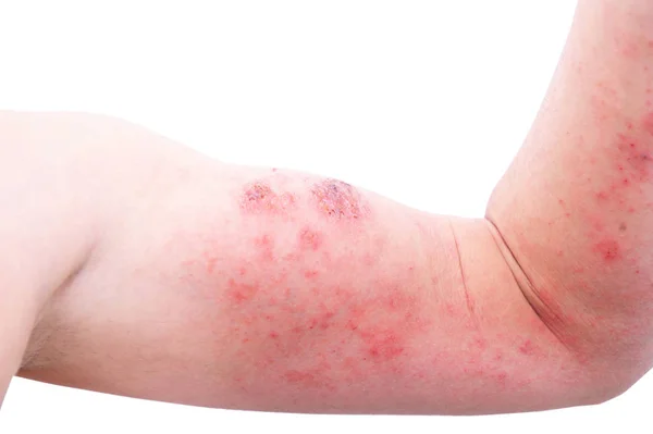 Atopisk Dermatit Även Känd Som Atopiskt Eksem Typ Inflammation Huden — Stockfoto