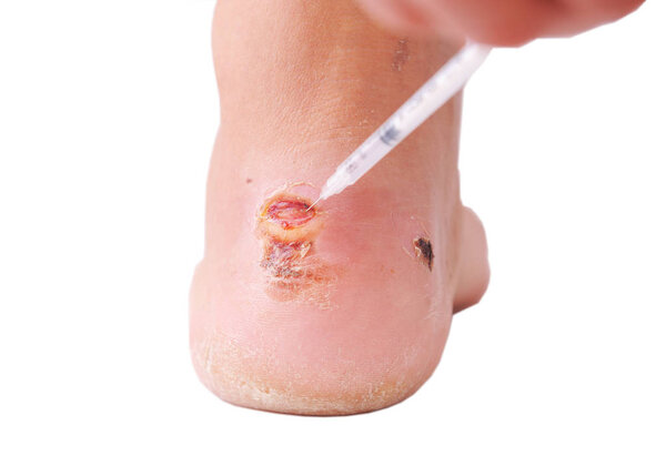 Callus on the leg of a young girl. female foot with problem areas on the skin, dry callus.