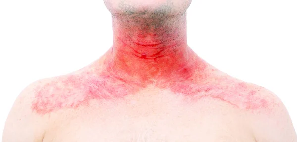 Dermatitis Atópica También Conocida Como Eccema Atópico Tipo Inflamación Piel —  Fotos de Stock