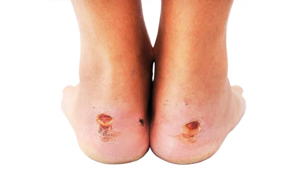 Drying Cleaning Cracked Bloody Blister Heel Very Painful Place Torn — Stock Photo, Image