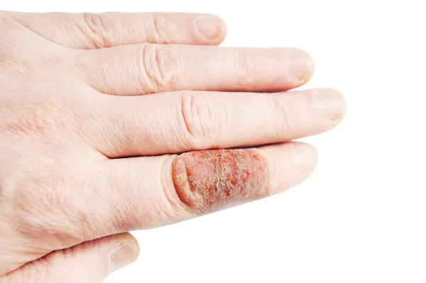 Dermatitis Atópica También Conocida Como Eccema Atópico Tipo Inflamación Piel — Foto de Stock