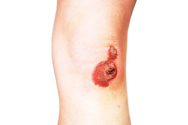 Bruised Wound Injury Knee Bruised Skin — Stock Photo, Image
