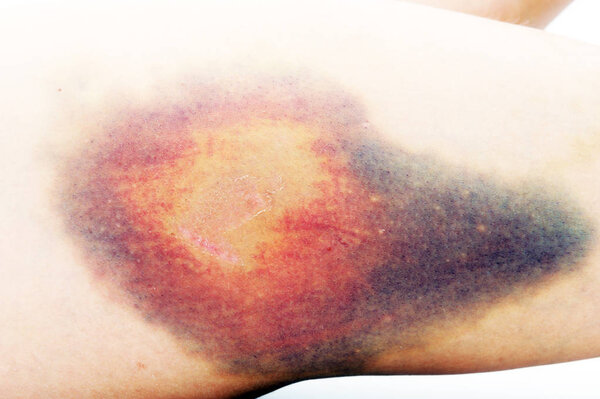 Молодая женщина с гематомой на бедре
