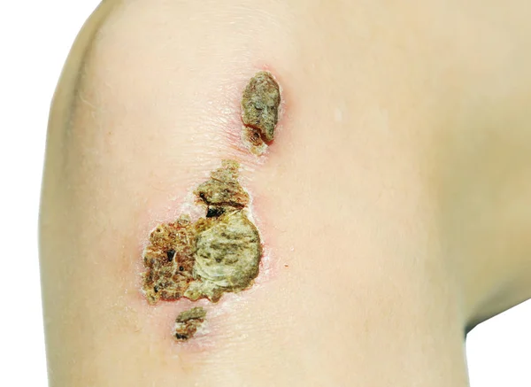 Bruised Wound Injury Knee Bruised Skin — Stock Photo, Image