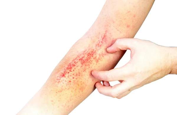 Atopic Dermatitis Also Known Atopic Eczema Type Inflammation Skin Dermatitis — Stock Photo, Image