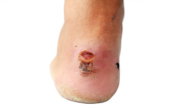 Naked Foot Painful Heel Wound Nature Man Feet Caused New — Stock Photo, Image