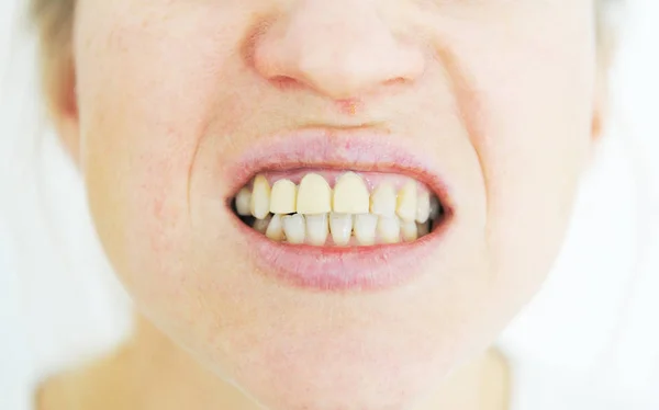 False Teeth Young Girl Years Old — ストック写真