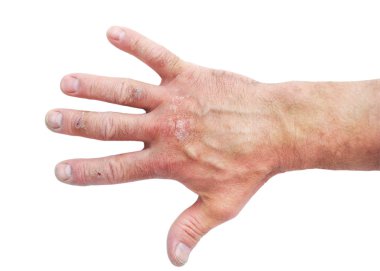 Atopik egzama olarak da bilinen dermatit (Atopik Deri İltihabı), cilt iltihabının bir türüdür.) .