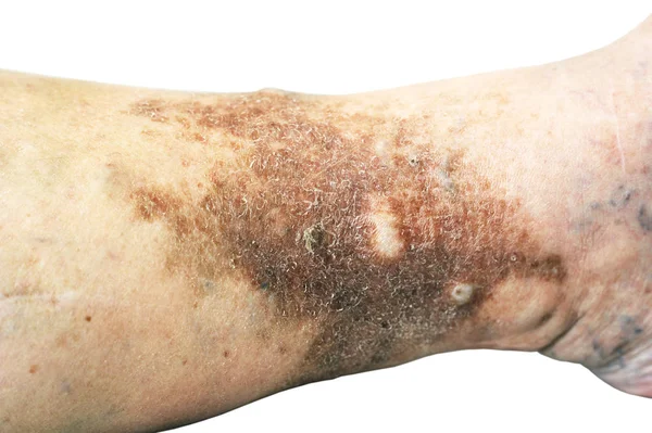 Atopické Dermatitidy Také Známý Jako Atopický Ekzém Druh Zánět Kůže — Stock fotografie