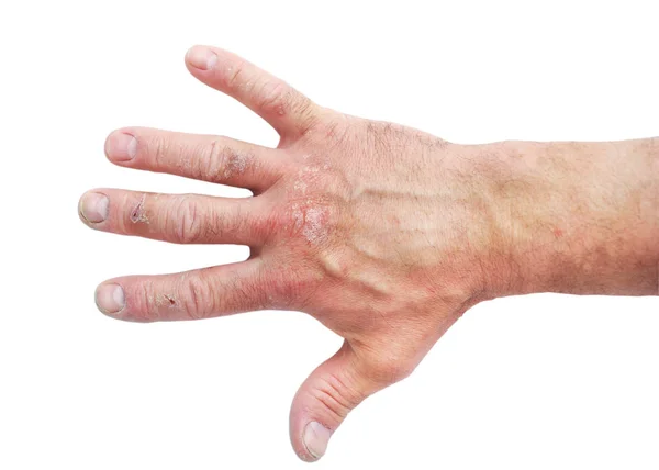 アトピー性皮膚炎 アトピー性皮膚炎とも呼ばれ 皮膚炎 皮膚炎 の一種です — ストック写真