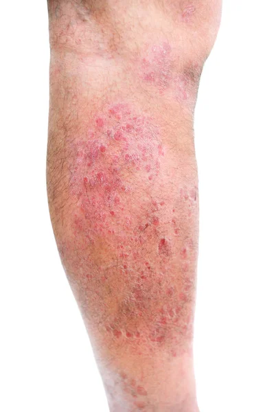 异位性皮炎 Atopic Dermatitis 简称Ad 又称特发性湿疹 Atopic Eczema 是一种皮肤炎症 — 图库照片