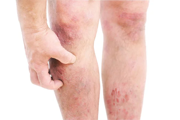 Dermatitis Atópica También Conocida Como Eccema Atópico Tipo Inflamación Piel — Foto de Stock